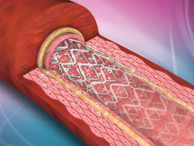 Stent coronarico - ReNATURAL - Cardionovum - in metallo / bioassorbibile