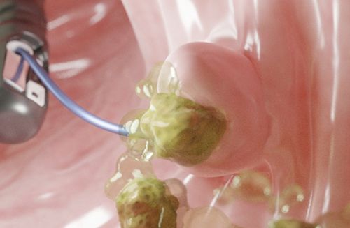 Catetere per estrazione di calcoli - Stonetrigger® - G-FLEX Europe - biliare / con palloncino / 7 Fr
