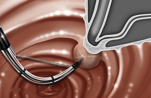 Sfinterotomo per sfinteretomia biliare - GTOME® - G-FLEX Europe