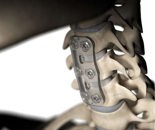 Placca per artrodesi per vertebra cervicale - S-1™ - Inion - in polimero bioriassorbibile / 2 livelli / 1 livello