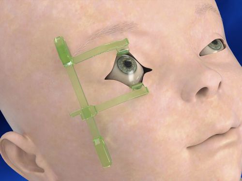 Speculum palpebre - Neotech Products - pediatrico / monouso