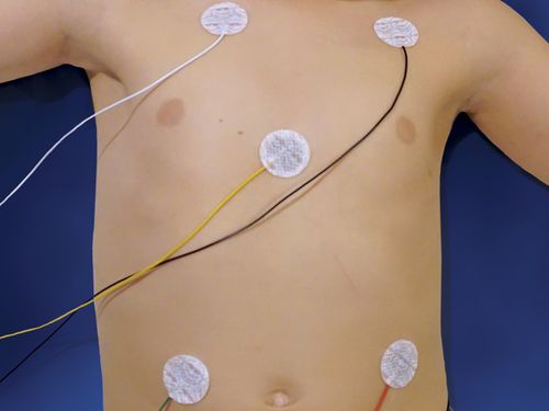 Elettrodo ECG pediatrico - NeoLead® - Neotech Products - di monitoraggio / radiotrasparente