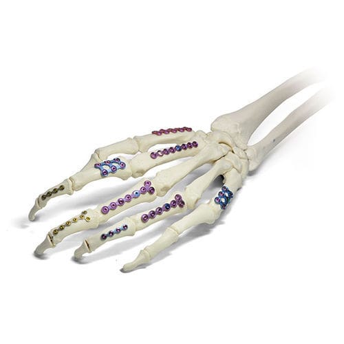 Placca di compressione per falange della mano - SIGNEX - OSTEONIC - bloccata / in metallo