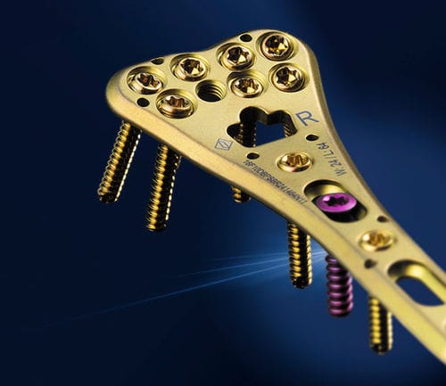 Placca di compressione per radio - SIGNEX - OSTEONIC - distale / bloccata / in metallo