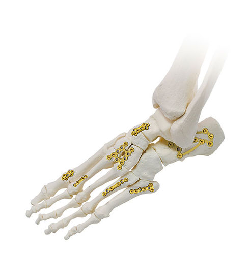 Placca di compressione per piede - SIGNEX - OSTEONIC - bloccata / in metallo