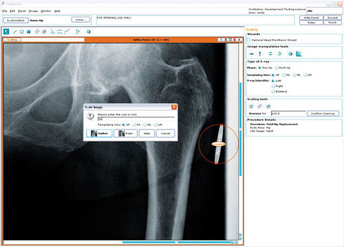 Software di pianificazione preoperatoria - Hip Arthroplasty - OrthoView - per chirurgia dell'anca / per chirurgia ortopedica / medico