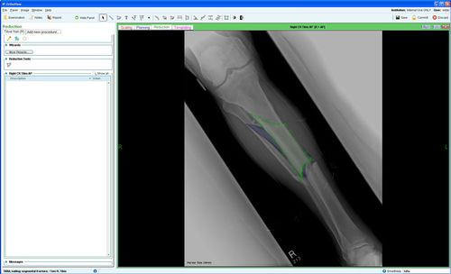 Modulo software di gestione - Fracture Management - OrthoView - per chirurgia ortopedica / di pianificazione