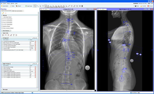 Modulo software di gestione - Spinal Deformity Assessment - OrthoView - di pianificazione preoperatoria / per chirurgia ortopedica / di rachide