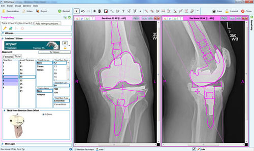 Software di pianificazione preoperatoria - Knee Arthroplasty - OrthoView - per chirurgia del ginocchio