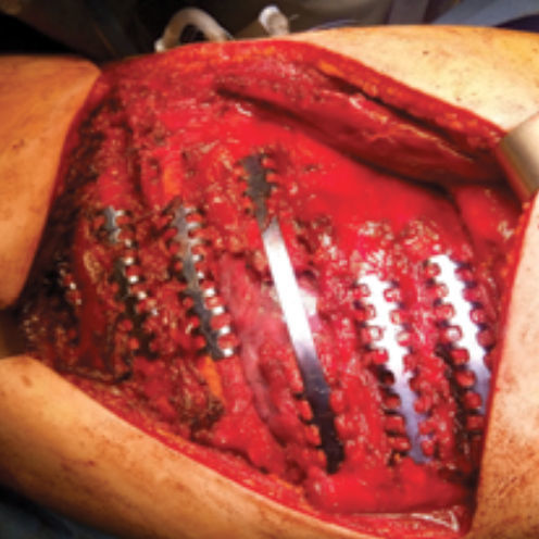 Protesi costale per ricostruzione dopo resezione di osteosarcoma - 37.706 series - Medicalex
