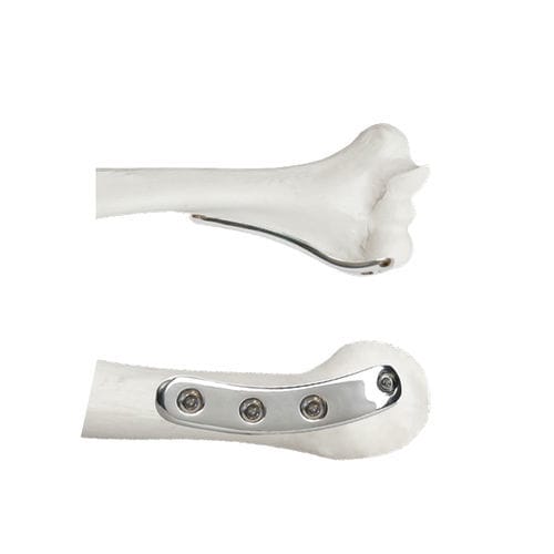 Placca di compressione per omero - 37.801 series - Medicalex - distale / laterale / bloccata