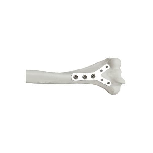Placca di compressione per epifisi - 37.802.0 series - Medicalex - per omero / distale / bloccata