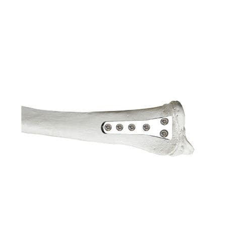 Placca di compressione per radio - 37.800 series - Medicalex - distale / bloccata / in metallo