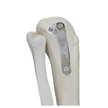 Placca di compressione per tibia - 37.803 series - Medicalex - prossimale / laterale / non bloccata