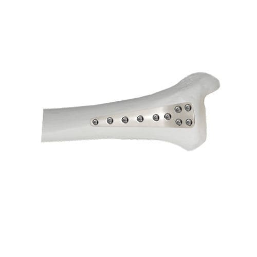 Placca di compressione per tibia - 37.804 series - Medicalex - distale / anterolaterale / bloccata
