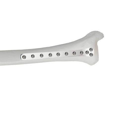 Placca di compressione per tibia - 37.804.0 series - Medicalex - distale / bloccata / in metallo