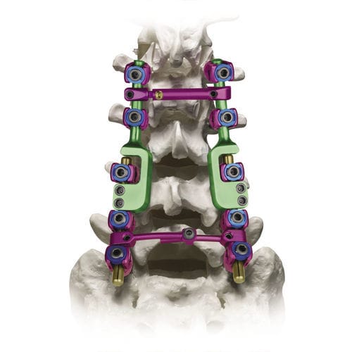Sistema di osteosintesi lombo-sacrale - REVERE® ADDITION® - Globus Medical - via posteriore / per adulti