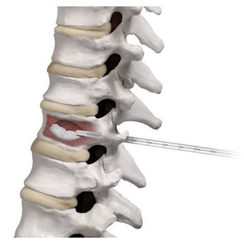 Sistema di aumento vertebrale ago - AFFIRM® - Globus Medical - per vertebroplastica percutanea