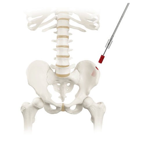 Ago per biopsia di midollo osseo - RETRIEVE® - Globus Medical