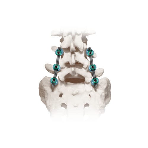 Sistema di osteosintesi lombo-sacrale - CREO® 5.5  - Globus Medical - via posteriore / per adulti