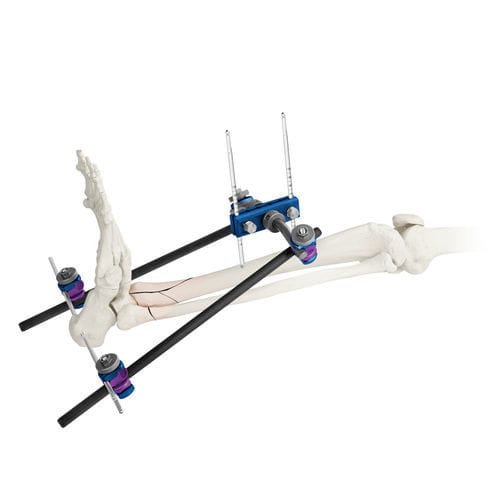 Fissatore esterno per caviglia - ARBOR® - Globus Medical - tubolare / per adulti
