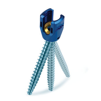 Vite peduncolare per vertebra lombo-sacrale - REVERE® Uniplanar - Globus Medical - poliassiale / in metallo