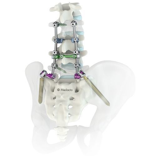 Sistema di osteosintesi lombo-sacrale - M.U.S.T.® - Medacta - via posteriore / per adulti