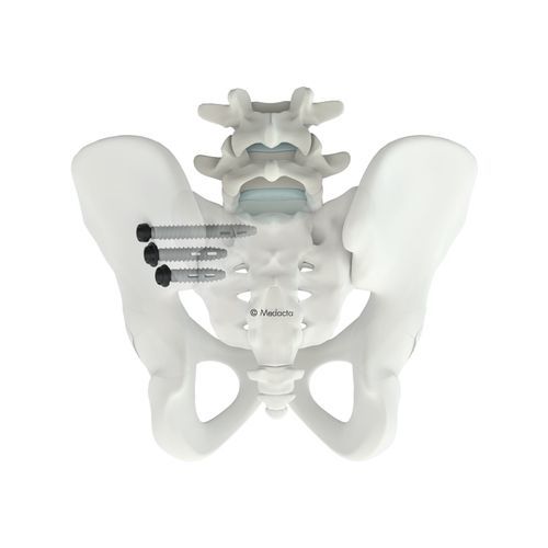 Sistema di osteosintesi sacroiliaca - M.U.S.T.® SI - Medacta - via posteriore / per adulti