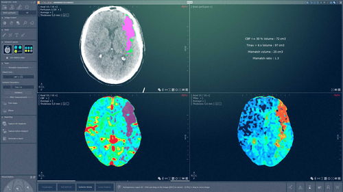 Modulo software per tomografia computerizzata - MYRIAN® XP-BRAIN - Intrasense - neurologico / di analisi / di gestione