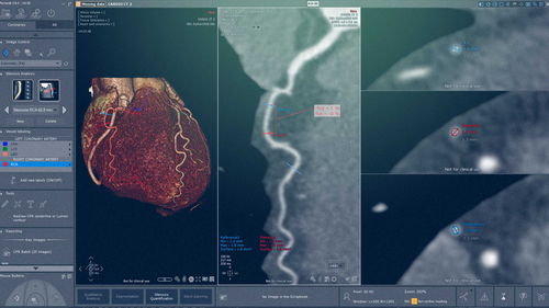 Modulo software per cardiologia - Myrian® XP-Cardiac - Intrasense - medico / di analisi / di visualizzazione