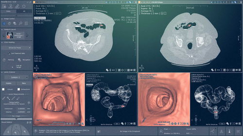 Modulo software di oncologia - Myrian® XP-Colon - Intrasense - per endoscopia / di analisi / di visualizzazione