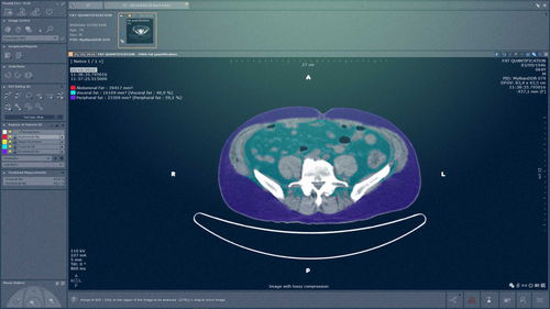 Modulo software medico - MYRIAN®XP-ABDOFAT - Intrasense - di quantificazione