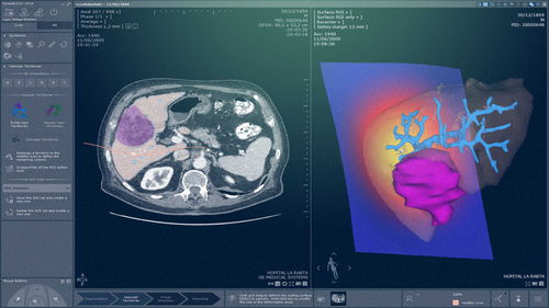 Modulo software medico - MYRIAN®XP-LIVER MRI - Intrasense - di analisi / diagnostico / di valutazione