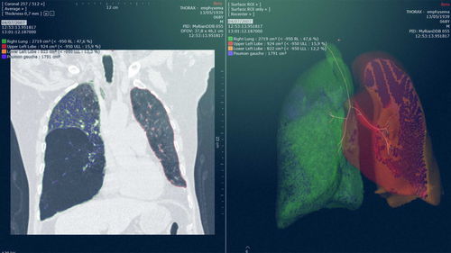 Modulo software di analisi - Myrian® XP-Lung - Intrasense - di pianificazione / di simulazione / per radiologia