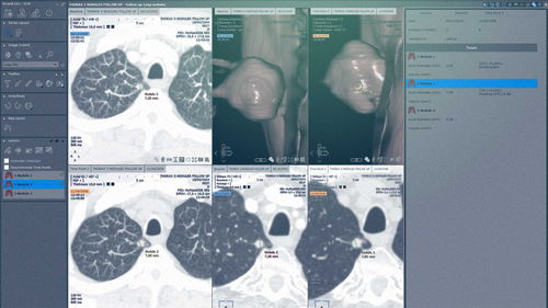 Modulo software per chirurgia - MYRIAN®XP-LUNG NODULE - Intrasense - di analisi / di visualizzazione / di valutazione