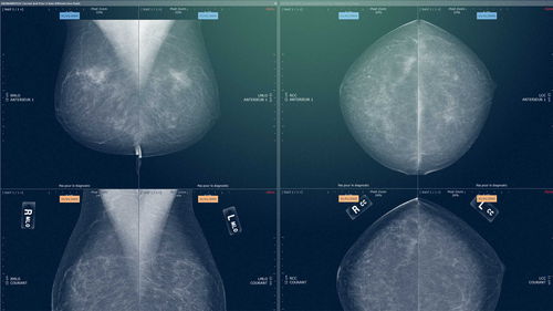 Modulo software medico - Myrian® XP-Mammo - Intrasense - per mammografia / di analisi / di visualizzazione