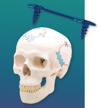 Sistema di fissazione cranica non assorbibile - NeuroPro® Low  - Kinamed