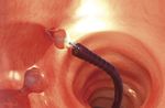 cestello endoscopico per estrazione di polipi intestinali