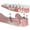 Vite per impianto dentale in titanio - MUS-9170 - Ditron Dental - multi-unità