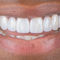 Set Di Denti Falsi In Resina Sintetica Easyinsmile, Tonalità A1, Superiore E Inferiore – Per Laboratorio Odontotecnico