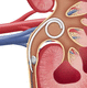 stent ureterale / in nitinol