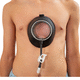 vacuum bell per correzione del pectus excavatum