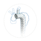 innesto stent per arco aortico / in nitinol / in polietilene