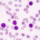kit di test della leucemia linfoblastica acuta / di oncologia / per medicina di precisione / genetico