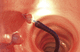cestello endoscopico per estrazione di polipi intestinali / dritto