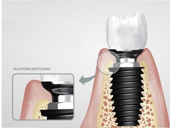 La Korea Dental Implant (KDI) Inc ha presentato il suo sistema d'impianto SLOCK.