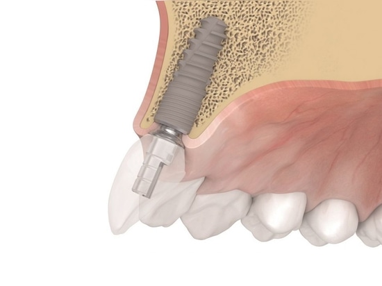 Dentaurum tioLogic TWINFIT