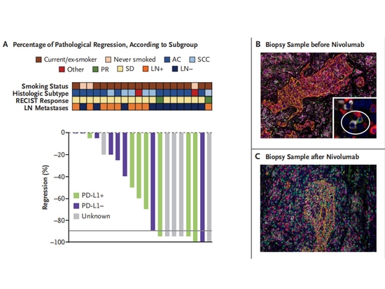 Breve sintesi dei progressi della ricerca sull'immunoterapia neoadiuvante nel NSCLC