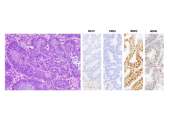 Ricerca sulla genotipizzazione di SpaceGen nel carcinoma endometrioide ovarico