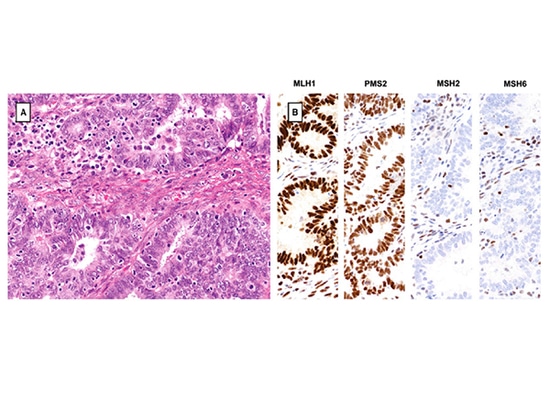 Ricerca sulla genotipizzazione di SpaceGen nel carcinoma endometrioide ovarico